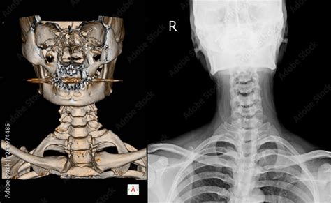 CT Scan Cervical Spine D Render And X Ray C Spine Finding Reverse Cervical Lordosis Thoracic