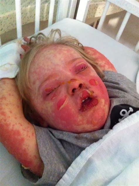 N engl j med 1995; 5 Types of Rare Skin Conditions | Health Digest