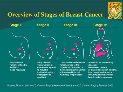 four stages of breast cancer