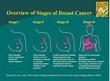 Stage 0 means the cancer is in one place. PPT - Overview of Breast Cancer Management PowerPoint ...
