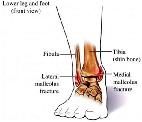 Ankle Fracture Icd 9 | Ankle Fracture | Pinterest