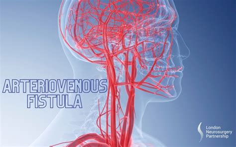 Arteriovenous Fistula London Neurosurgery Partnership