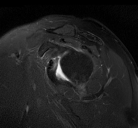 Greater Tuberosity Avulsion Fracture Image Radiopaedia Org