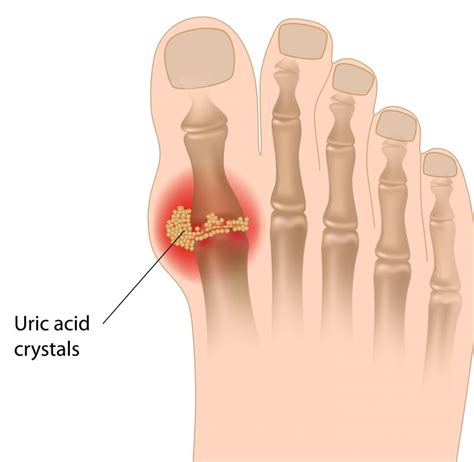 What Are Common Causes Of Big Toe Joint Pain With Pictures