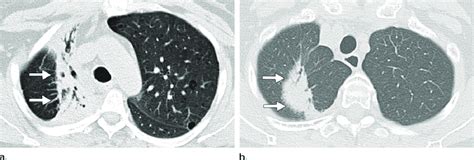 Radiologic Appearance Of Late Conventional Radiation Fibrosis Changes