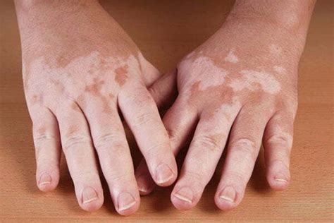 Common Chronic Skin Conditions