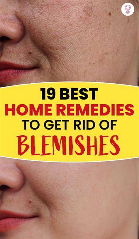 19 Best Home Remedies To Get Rid Of Blemishes On Face Artofit