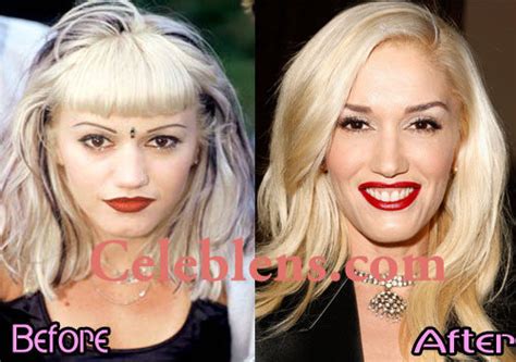 So, has stefani actually had any plastic surgery in her life? Gwen Stefani Plastic Surgery Before And After Photos