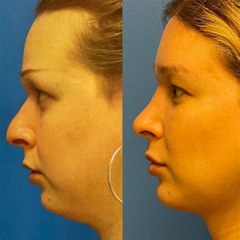 Facial Feminization Austin Tx Dr Weinfeld