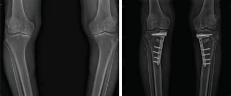 High Tibial Osteotomy A Guide For Orthopedic Surgeons