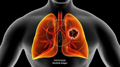 Medical Illustration Of Lung Cancer Inside The Human Lungs Stocktrek