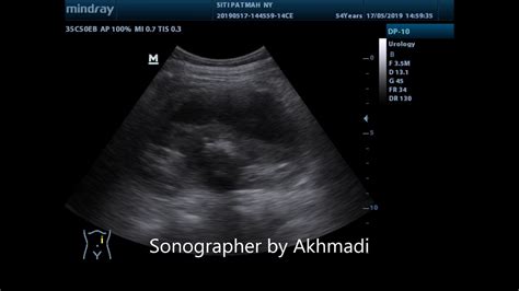 Urinoma Kidney Ultrasound Youtube