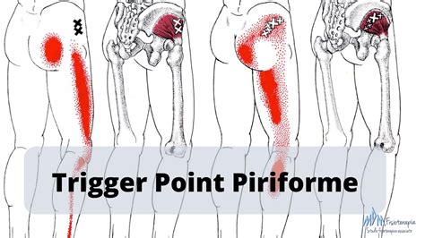 Trigger Point Piriforme Scopri Come Agire Mdm Fisioterapia