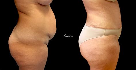 O faustão seguiu o caminho de outros famosos, mesmo após muita resistência, em 2009 faustão fez a cirurgia bariátrica, e chegou a emagrecer 30 bem esta foi a lista dos 8 famosos brasileiros antes e depois do emagrecimento, compartilhe esta postagem assim seus amigos do facebook poderão. Lipoabdominoplastia (Imagens Antes e Depois) - Caso ...