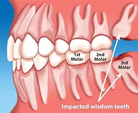 Wisdom Tooth Removal Fremont Ca Your Caring Dentist