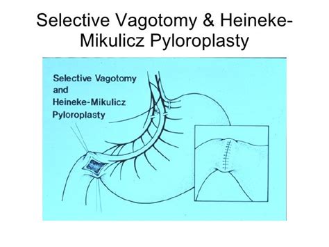 Surgery Stomach And Duodenum Tg