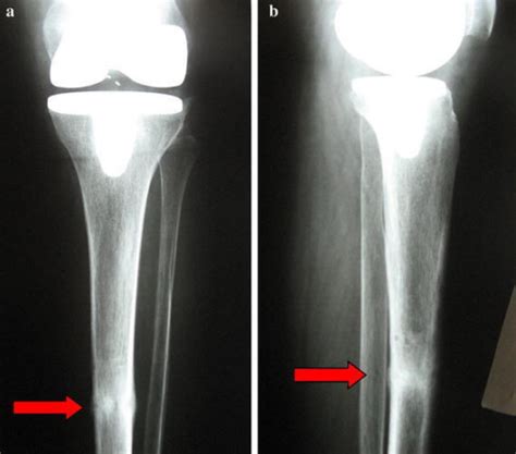 a Antero-posterior (AP) X-ray: good healing of the tibi ...