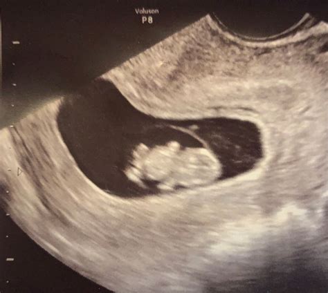 8 9 Week Ultrasound Babycenter