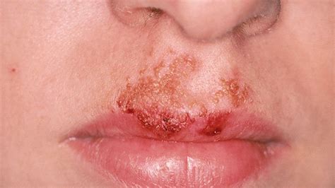 Impetigo Signs Symptoms And Diagnosis Everyday Health