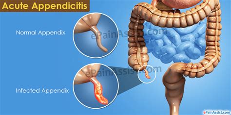 Causes Of Appendicitis Appendicitis In Nigeria Nigeria Health Blog