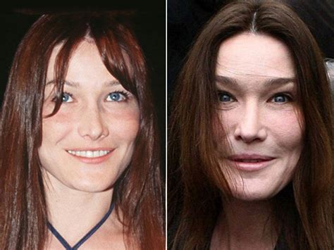 Carla Bruni 5 Beauties Who Took Plastic Surgery Too Far