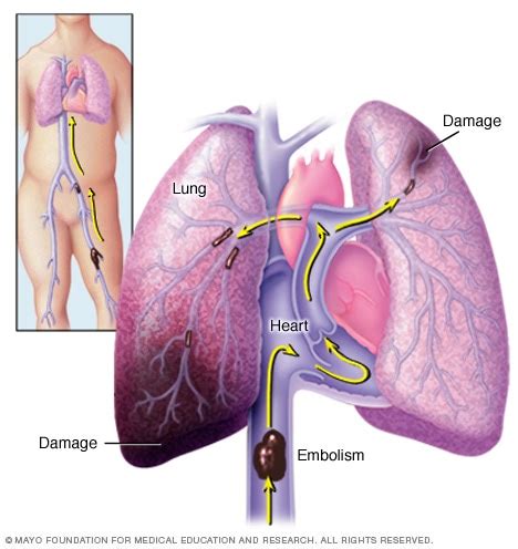 Embolia Pulmonar S Ntomas Y Causas Mayo Clinic