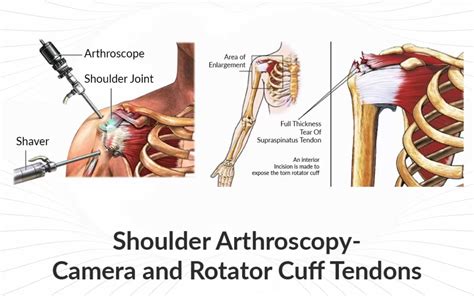 Rotator Cuff Surgery And Recovery Shoulder Surgery