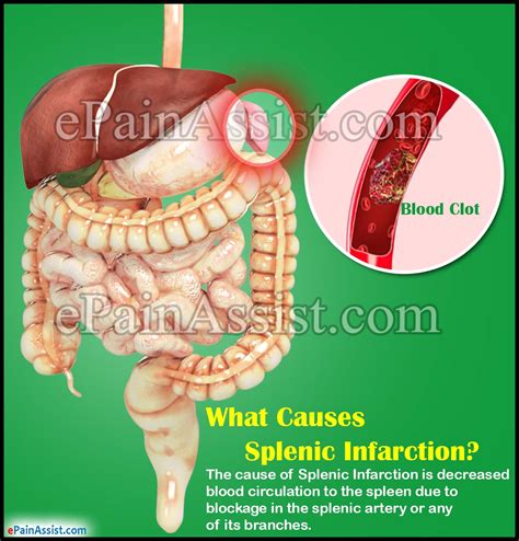 What Causes Splenic Infarction And How Is It Treated