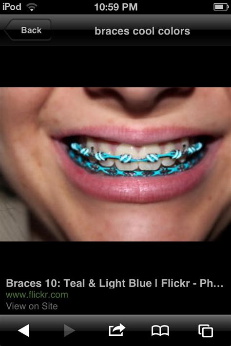 Sky Blue Braces Bands Tinareedorthodontics