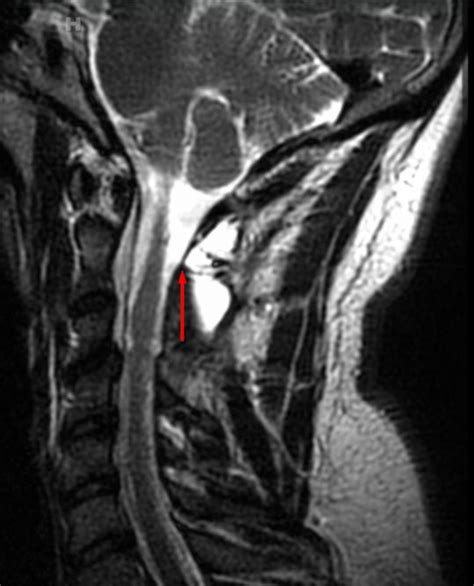 Cervical Spine Sagittal Mri Without Contrast Showing A Near Complete