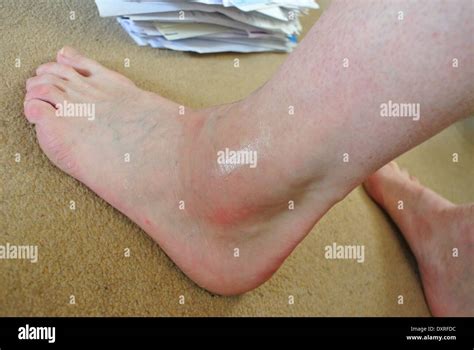 Gout Ankle Swelling Stock Photo Alamy