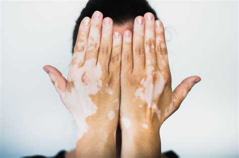 Light And White Skin Patches All You Need To Know About Vitiligo Goqii