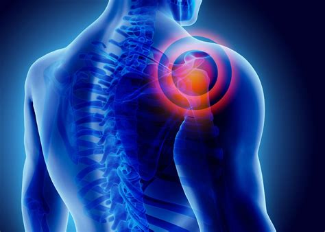 What Is Frozen Shoulder Adhesive Capsulitis Symptoms And Causes