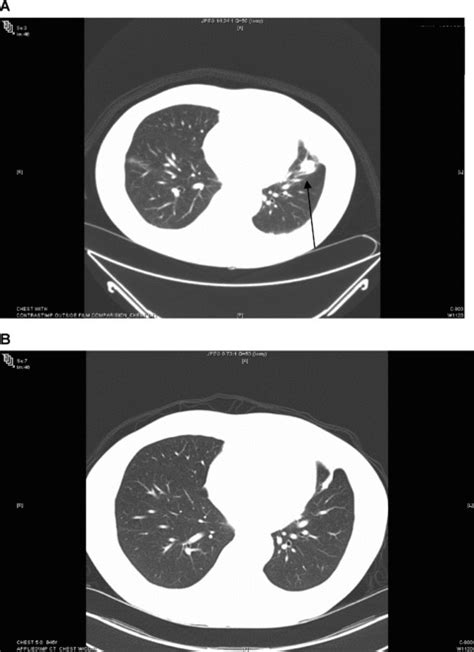 Chest Computed Tomography Ct Scans Before Sorafenib Therapy A And