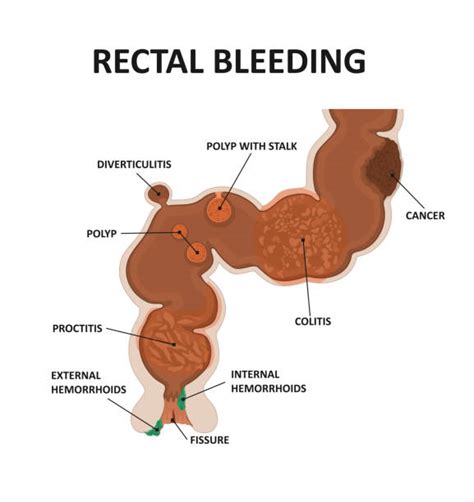 Rectal Exam Illustrations Royalty Free Vector Graphics And Clip Art Istock