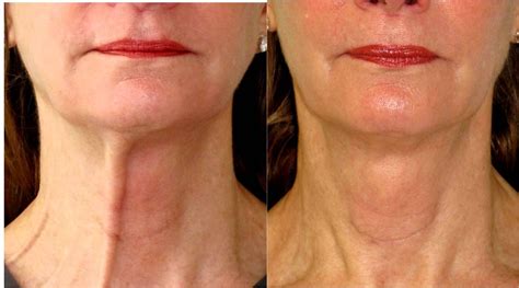 Botox for neck bands #botox #dysport #juvederm #restylane #sculptra #