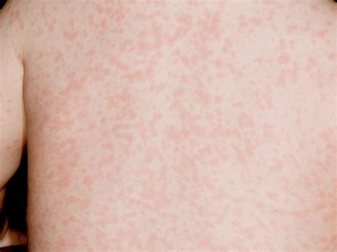 Us Measles Outbreak Worrisome Cdc Official Says