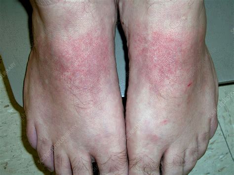 Allergic Contact Dermatitis Stock Image C0570627 Science Photo