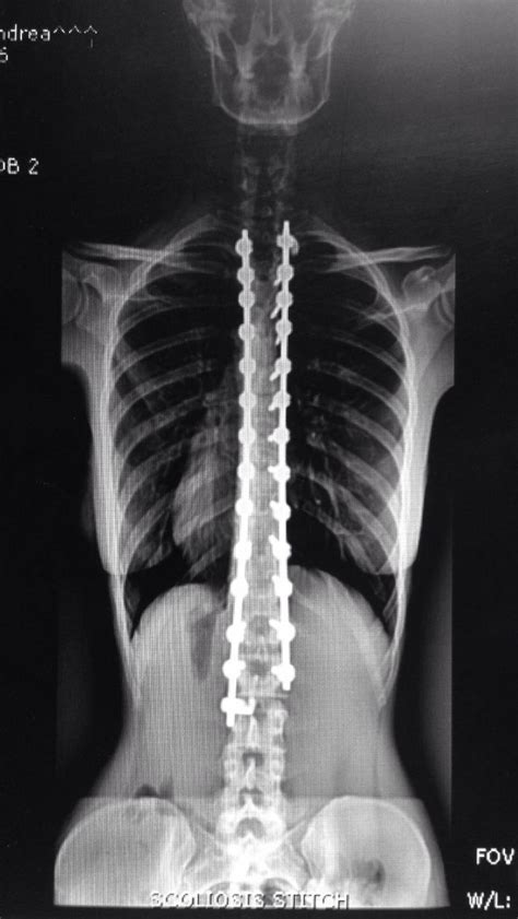 2 12 Month Post Op X Ray Of My Spinal Fusion Spinal Fusion