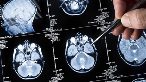 Síntomas De Un Tumor En El Cerebro Todo Lo Que Debes Saber
