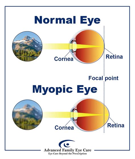 Pathological Myopia Causes