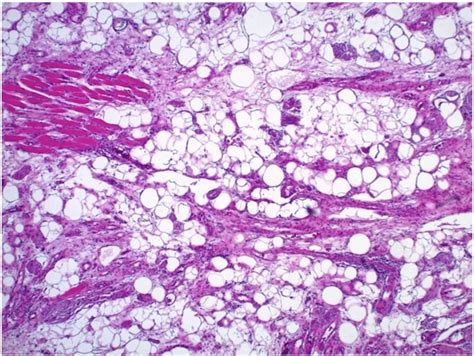 Mature Adipose Tissue Diffusely Infiltrating Among Scattered Atrophic