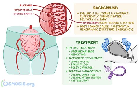 Boggy Uterus What Is It Causes Treatment And More 40 Off