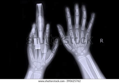 Xray Show Fracture Middle Finger Left Stock Photo Shutterstock