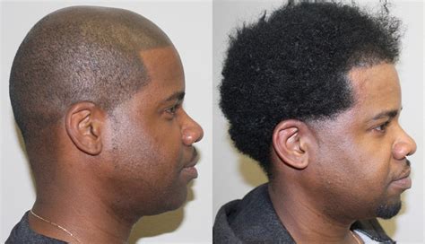 Black female hair transplant before and after. Great Hair Transplants Patient African American Hair ...