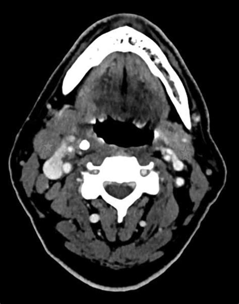 Axial Neck Ct Scan With Iv Contrast Approximately 17 Days Following