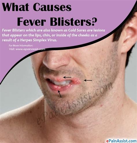 Creative Method How To Relieve Fever Blisters