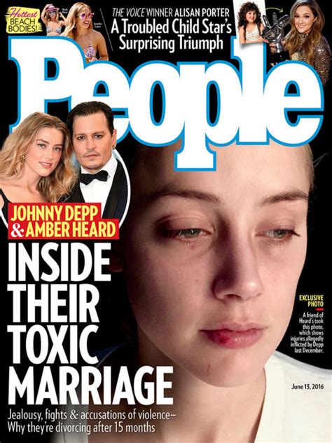 Amber Heard Reveals More Injuries Allegedly Caused By Johnny Depp In