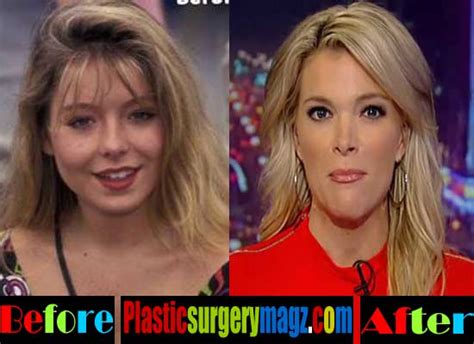 Megyn Kelly Plastic Surgery Before And After Photos