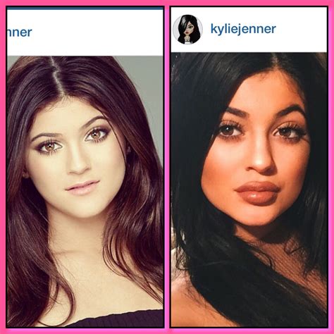 kylie jenner plastic surgery before and after kylie jenner plastic surgery has raised lots of